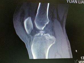 小腿骨折照片,影像学特征与治疗策略